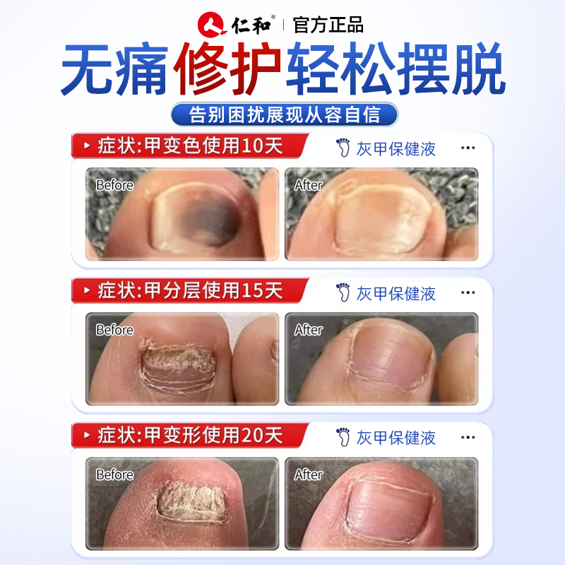 仁和医用灰指甲专用药强效去灰甲脚指甲变色浑浊修复亮甲专用