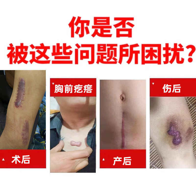疤痕增生凸起去除胸前瘢痕疙瘩软化针修复烫伤后疤体质痒专用膏贴,淘宝优惠券,粉丝福利购,淘宝优惠卷