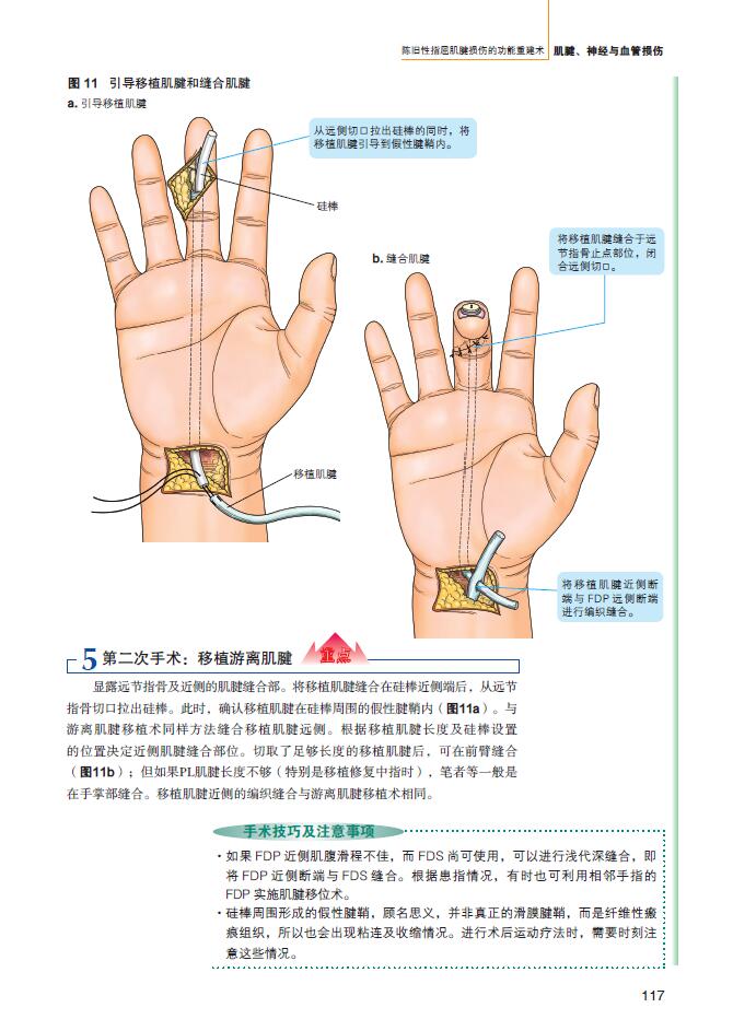 手外伤重在早期恢复功能骨科手外科手术图谱骨与关节损伤骨折皮瓣软组织缺损断指再植术甲沟炎诊断治疗书籍手外科手术操作规范-图1