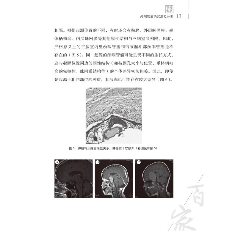 颅咽管瘤2024观点 主编 漆松涛 刘忆 颅咽管瘤命名的演变及分类 神经病学与精神病学 医学书籍 科学技术文献出版社9787523517192