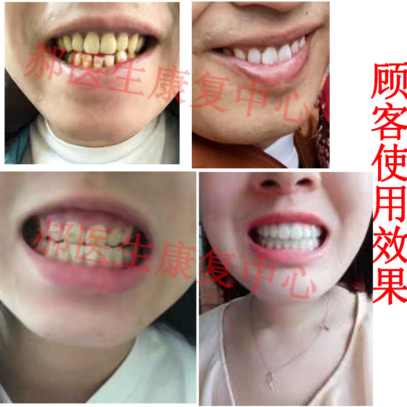 正品牙斑净牙齿美白洗牙去黄牙垢烟渍黑黄速效白牙素牙班神器洗白