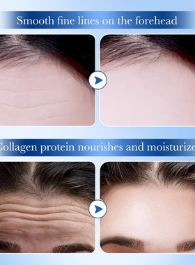ForeheadLineRemovalPatch