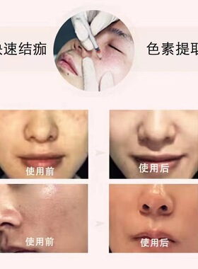 祛斑液提取液无尴尬期雀斑老年斑色素分解液调肤液代谢美白滋润