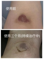 Repair of scar Hyperplasia Softening Goose Bumps Traditional Chinese Medicine Patch With Burns And Scalds