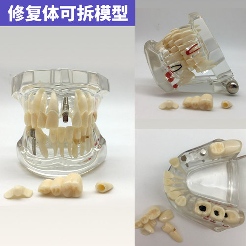 牙科教学模型口腔全口牙齿病理修复体牙模型标准种植模具医患沟通 - 图1