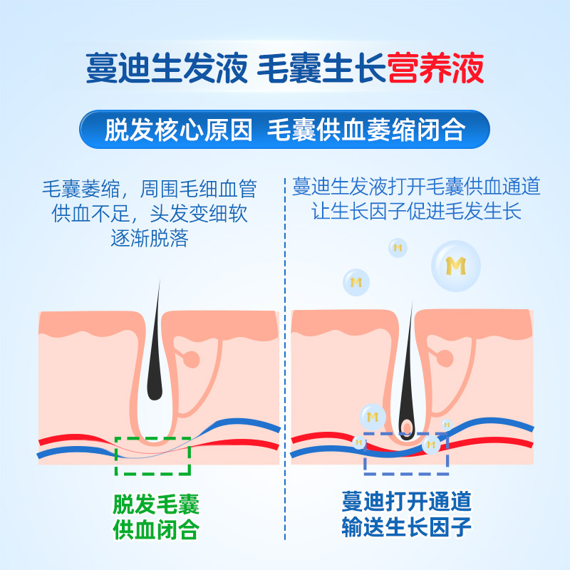 蔓迪米诺地尔酊町正品生发液发际线长头发增长液男女性曼迪旗舰店 - 图3