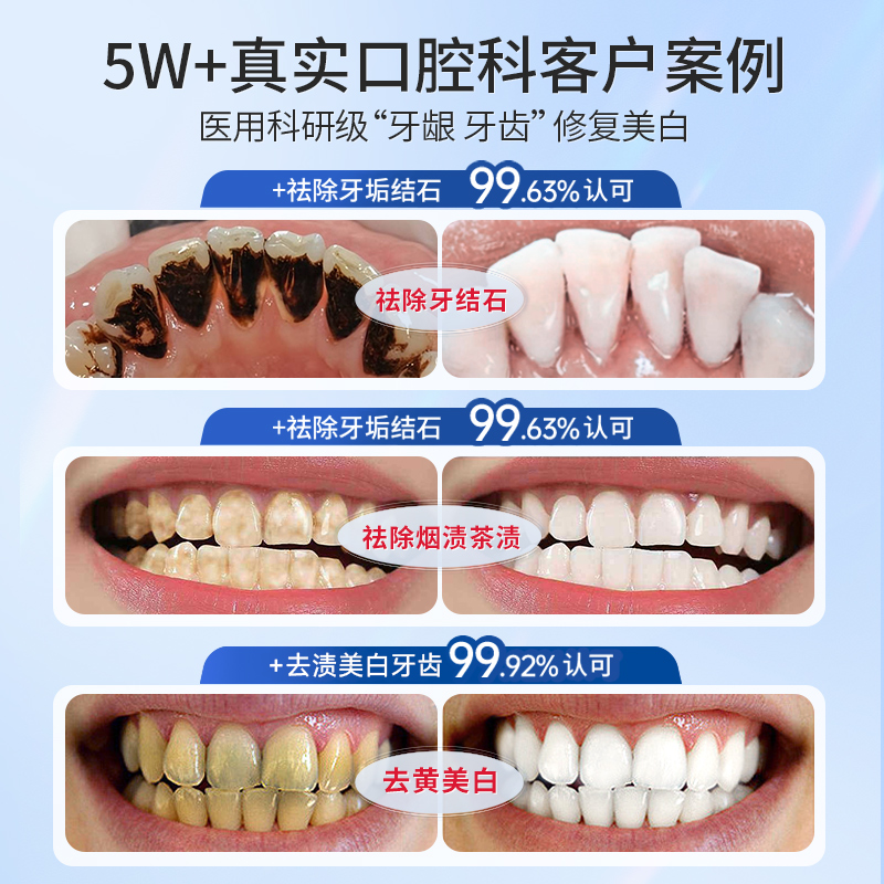 牙结石牙膏专用洗牙齿污垢牙石去溶解牙渍去除器牙垢黄牙神器除