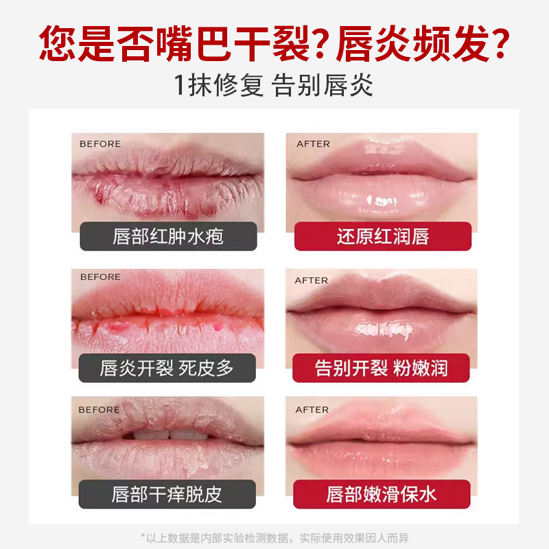 唇炎润唇膏嘴唇干裂脱皮专用保湿滋润去死皮口角炎疱疹医用修护膏