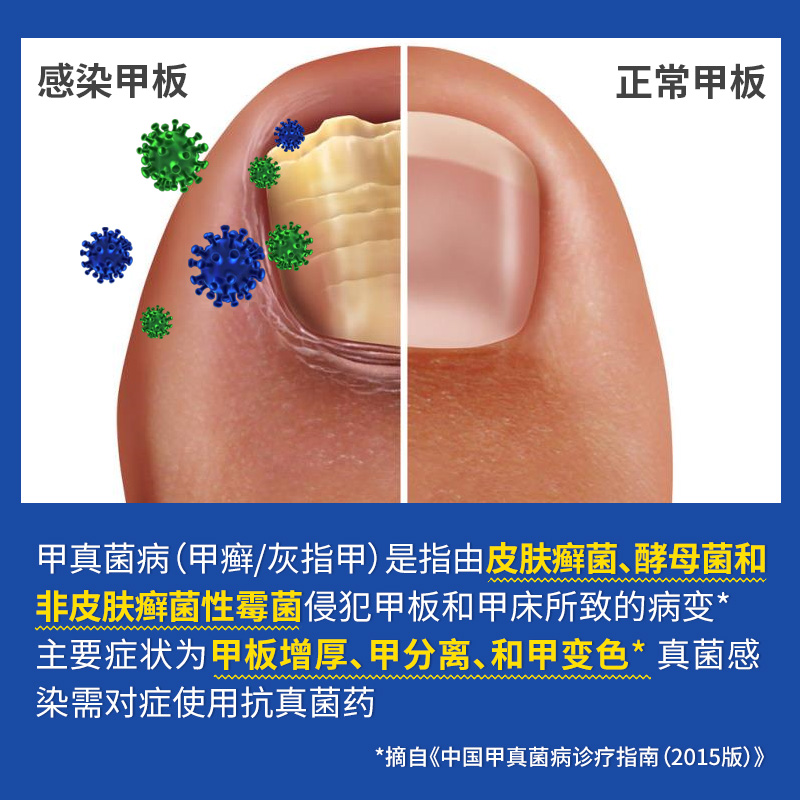 阿里健康大药房阿萝芬盐酸阿莫罗芬搽剂擦剂甲涂剂脚气灰指甲治疗专用药阿姆罗芬1