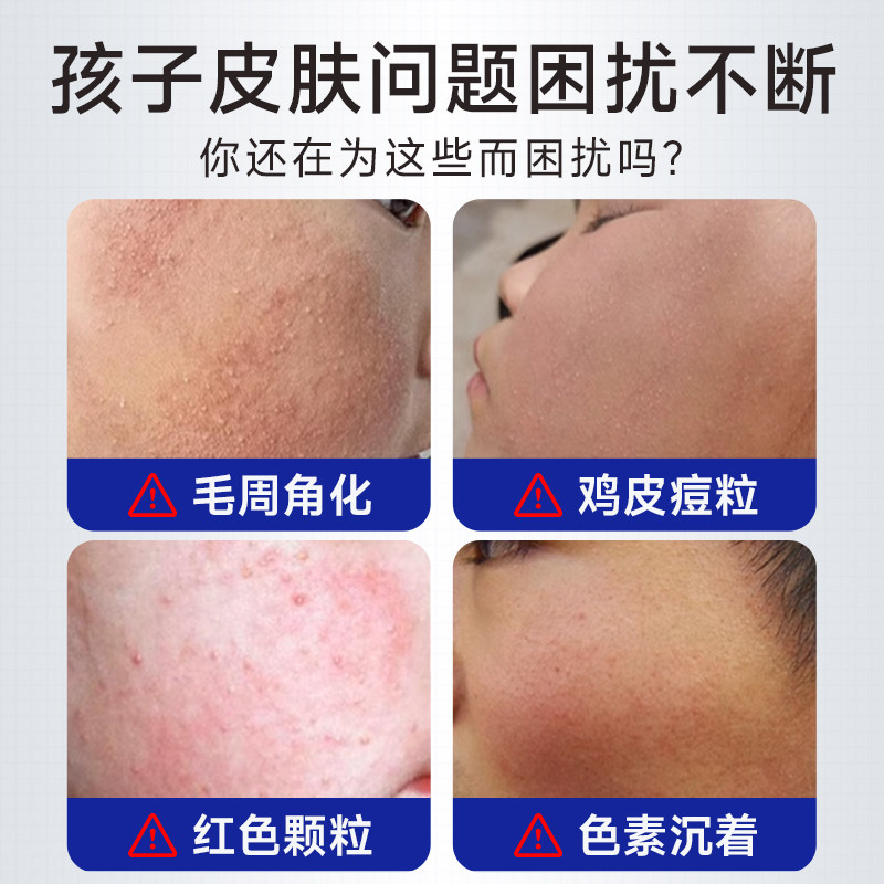 医用儿童鸡皮肤疙毛周角化脸上小瘩颗去除死皮粒面部角质敷料正品,淘宝优惠券,粉丝福利购,淘宝优惠卷