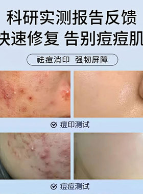 修正壬二酸祛痘膏急救去红肿痘痘褪红痤疮修复淡化痘印痘坑去黑女