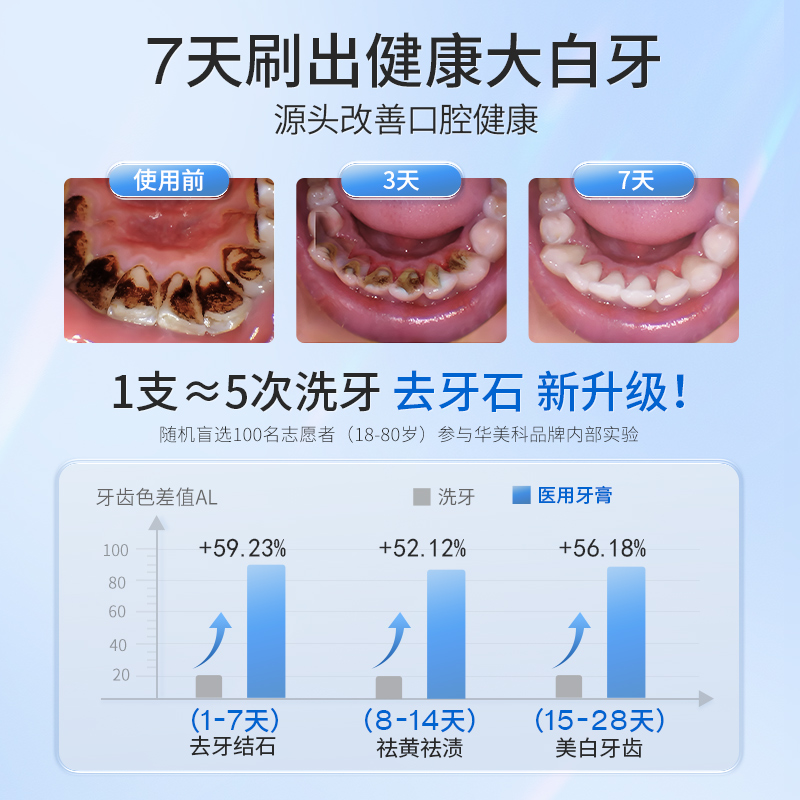 牙结石牙膏专用洗牙齿污垢牙石去溶解牙渍去除器牙垢黄牙神器除