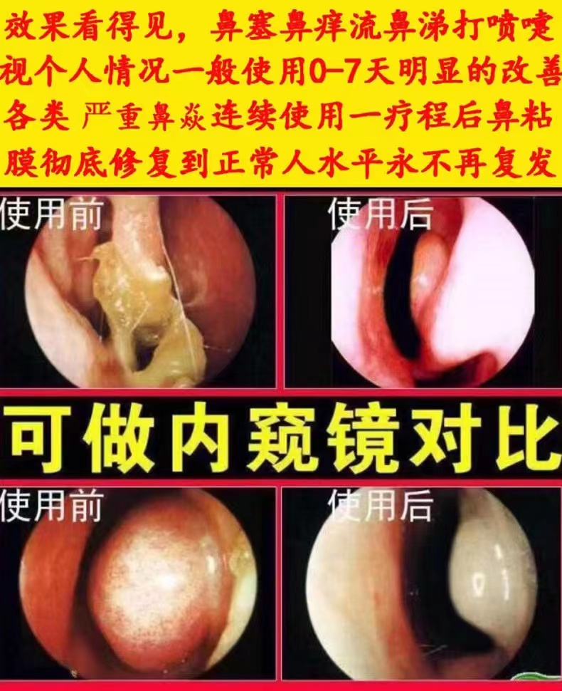 鼻炎膏纯中药治疗过敏性打喷嚏急慢性鼻窦炎克星鼻塞通鼻鼻涕神器 - 图2