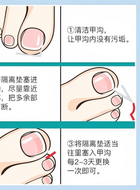 甲沟矫正器正甲贴指甲贴片嵌甲脚趾甲往肉里长纠正隔离填充垫片