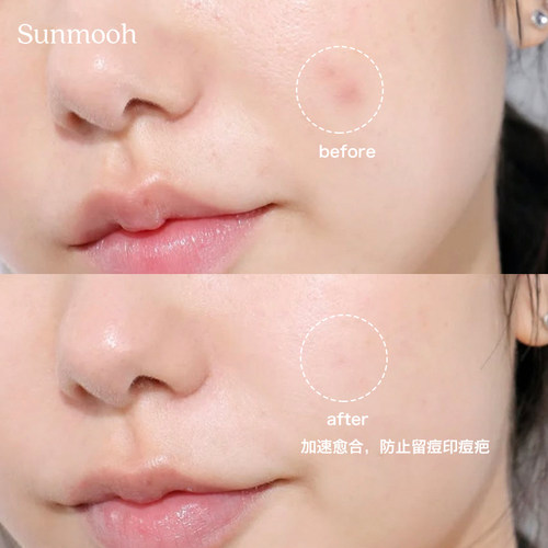 【Sunmooh】痘肌战神▲韩国ORJENA痘痘贴祛痘吸脓隐形预防痘印 - 图1