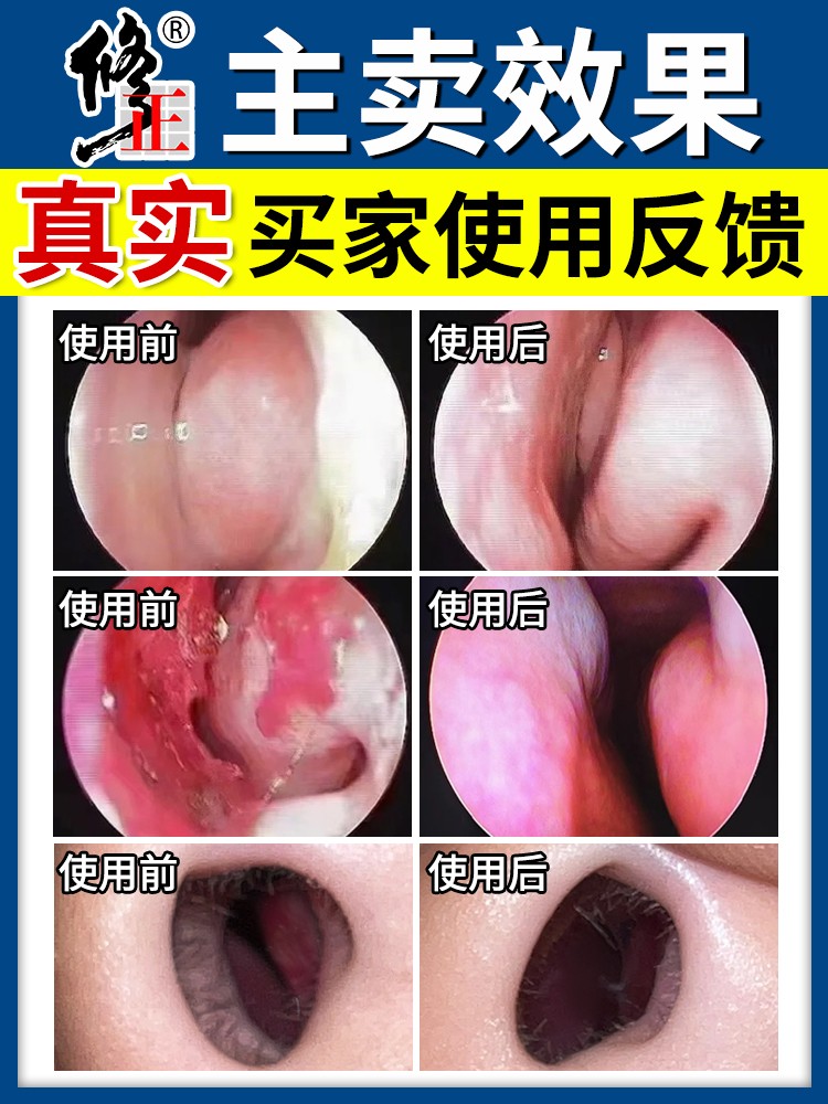 修正鼻用过敏原阻隔剂抗鼻腔过敏凝胶正品性鼻炎喷剂膏MM10 - 图0