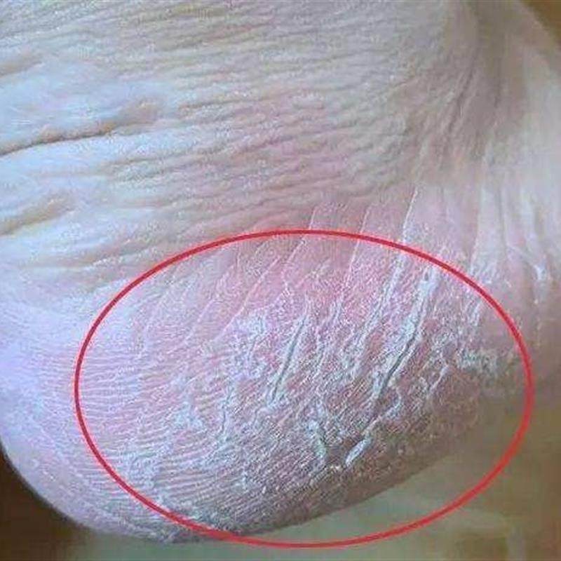 百修福皲裂膏皮肤干燥脚干裂脱皮异味脚痒脱皮脚汽买3送1买5送2,淘宝优惠券,粉丝福利购,淘宝优惠卷