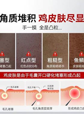 日本京都鱼鳞鸡皮疙瘩毛囊角化去角质身体乳疏通毛孔堵塞干燥起皮