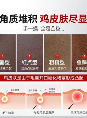 日本京都鱼鳞鸡皮疙瘩毛囊角化去角质身体乳疏通毛孔堵塞干燥起皮