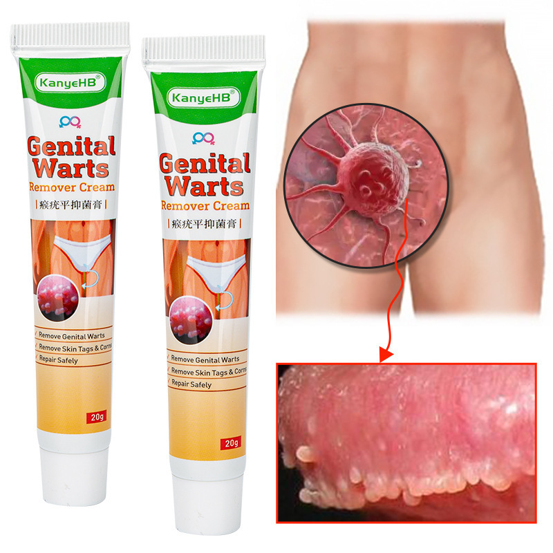 平猴尤祛疣膏 Wart Remover Cream Wish亚马逊 Ebay Lazada 20g-图0
