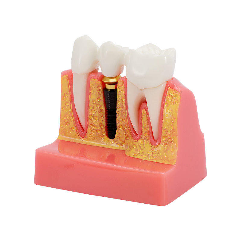 牙齿模型口腔教学幼儿园摆件牙龈修复种植教具可拆卸儿童全口牙模-图3