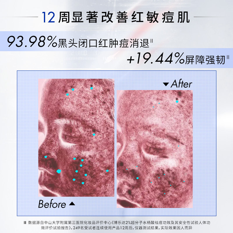 博乐达水杨酸去黑头闭口粉刺控油 broda博乐达涂抹面膜