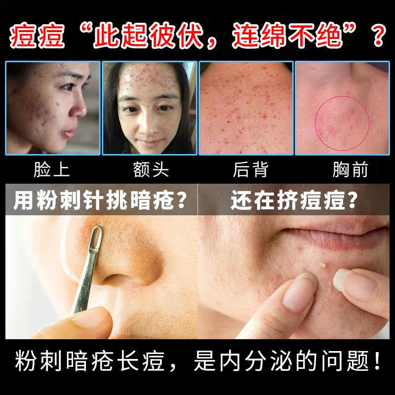 九鑫治疗粉刺清热解毒90清热暗疮丸 世纪本草大药房皮脂汗腺