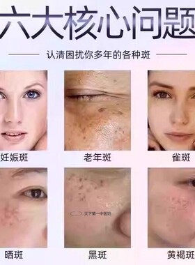 去老年斑的药膏去除脸部手部班专用中老年人祛斑霜黄褐斑美白正品