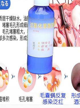 过氧苯甲酰5%洗剂100ml酒-渣鼻介疮痘痘效果好