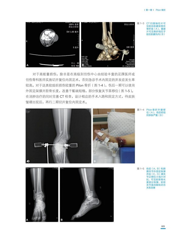 正版包邮 积水潭医院创伤骨科手术技术 足踝骨折 北京积水潭医院手术经验全景展示 北京科学技术出版社9787571412326