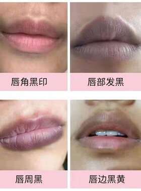 改善唇部护理周围淡化唇周去黑嘴角发黑去除美白去黑色素嘴边去黑