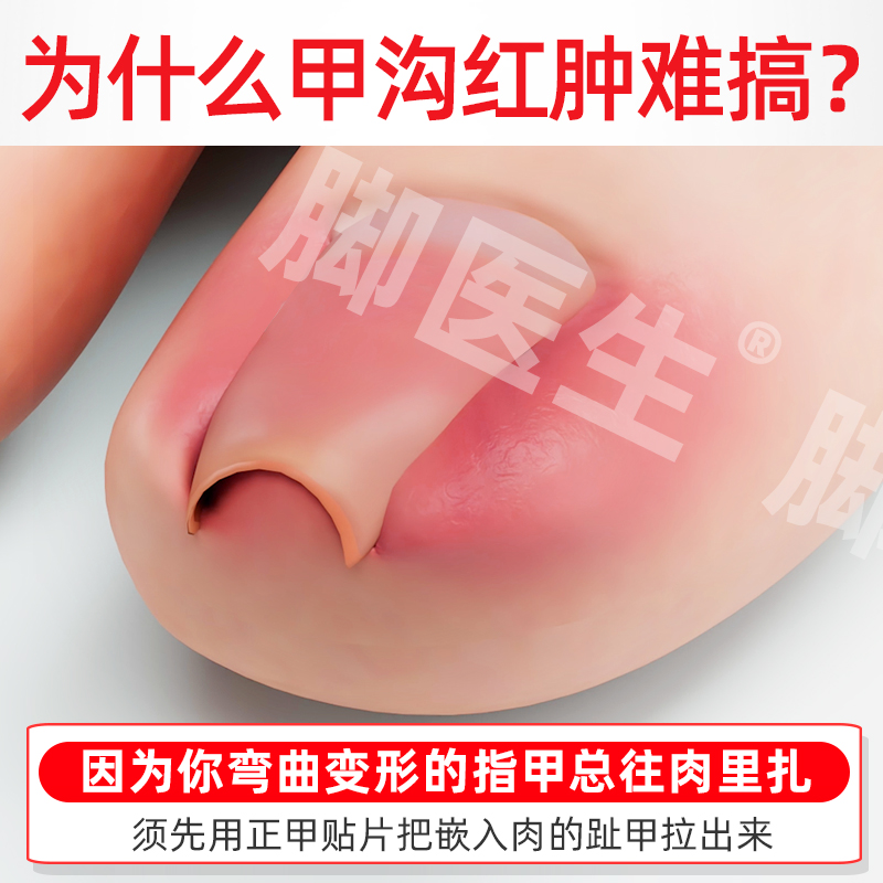 脚医生旗舰店甲沟炎专用嵌甲膏矫正器脚指甲软甲正甲贴息肉去除片
