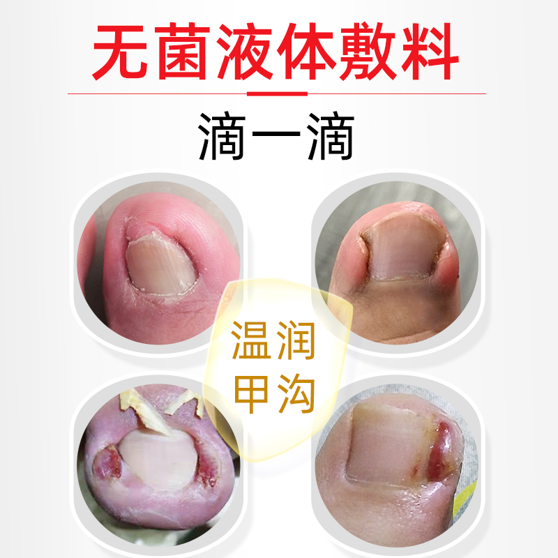 脚医生旗舰店甲沟炎专用嵌甲膏矫正器脚指甲软甲正甲贴息肉去除片