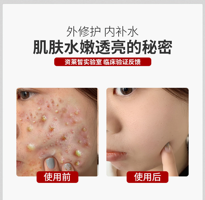 医美冷敷贴中药无菌祛痘医用面膜 领航奉献爱方伤口敷料