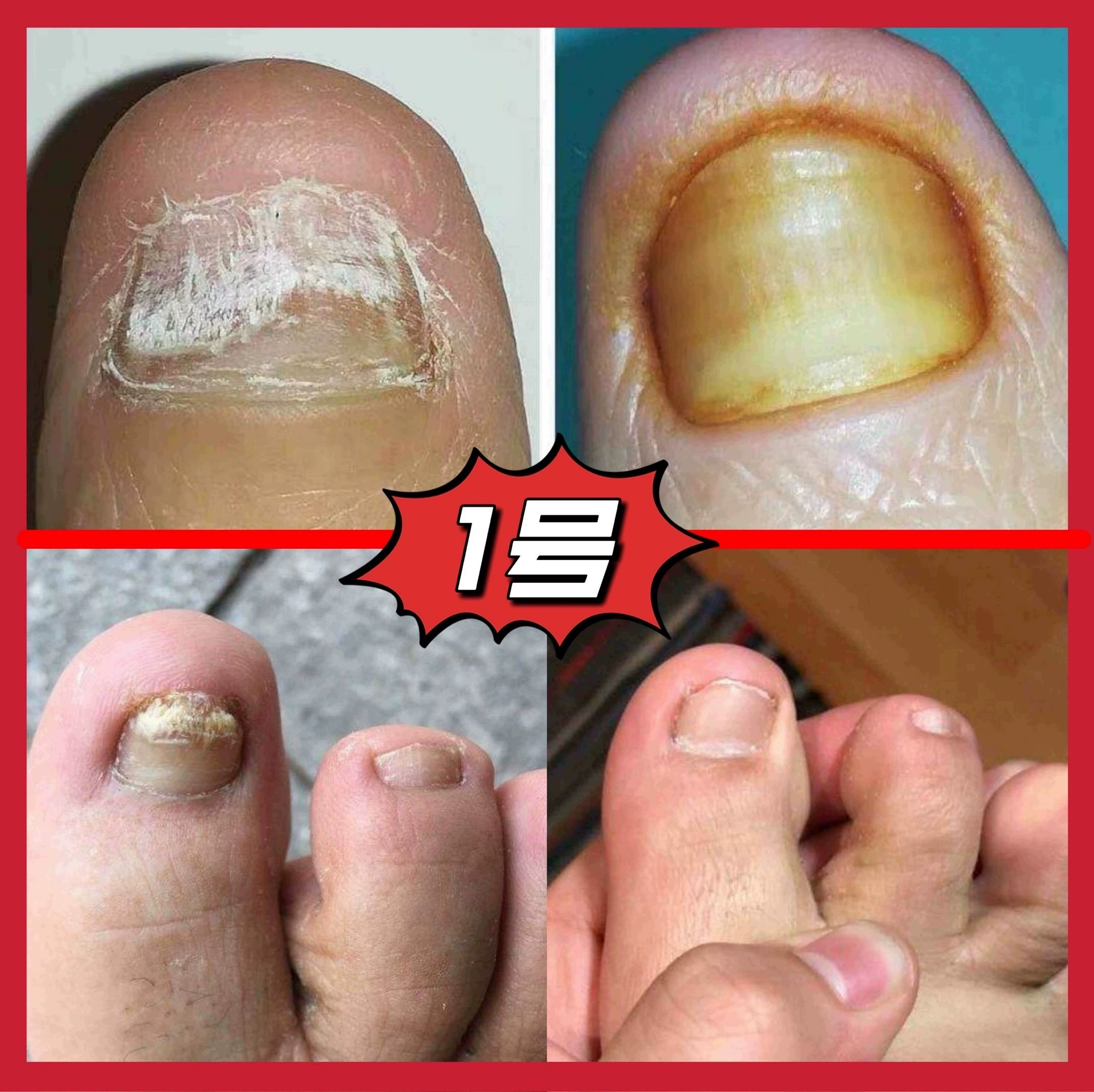 灰3 空甲厚甲分层萎缩变色浑浊凹凸竖纹甲发黑发黄变脆 - 图0