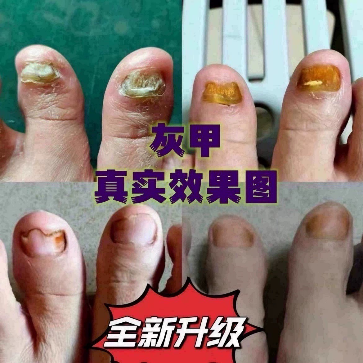 灰3 空甲厚甲分层萎缩变色浑浊凹凸竖纹甲发黑发黄变脆 - 图1