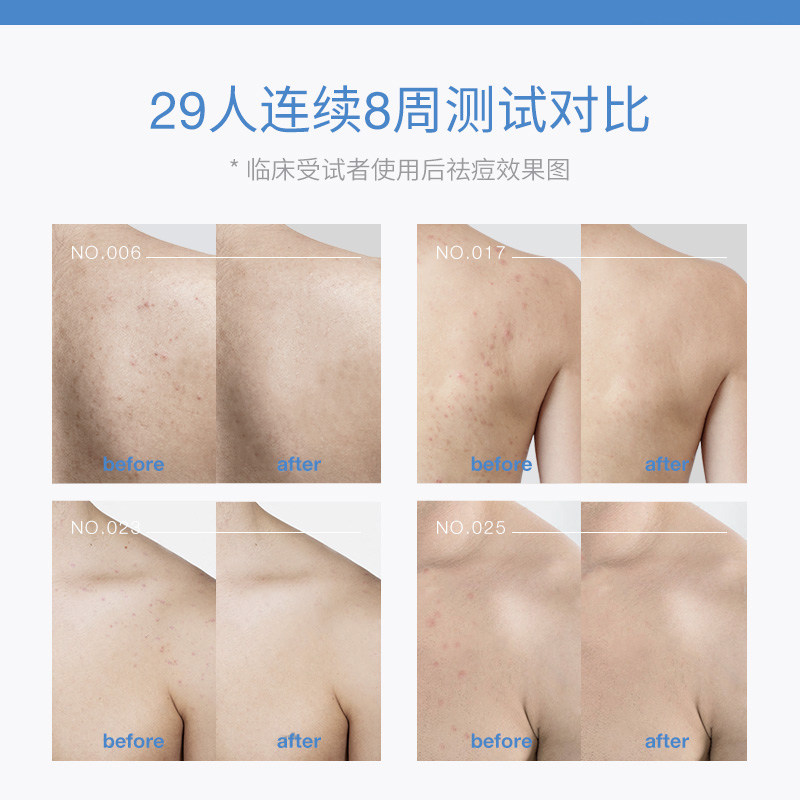 背上神器身体除螨去螨虫皂 满婷弘厚香皂