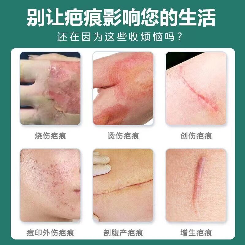  希欢医疗器械祛疤产品