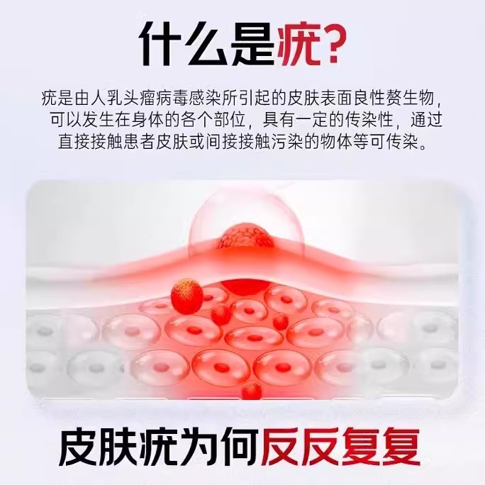 哲也医生祛疣型医用退热凝胶去尤膏医疣瘊用扁平疣官方旗舰店正品