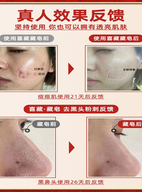 喜藏藏皂正品官方套装除螨黑头粉刺男女学生洗脸清洁控油手工臧皂