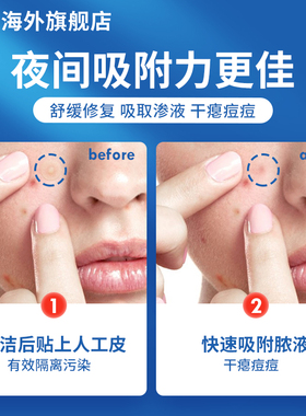 3M痘痘贴亲水性敷料人工皮吸修复