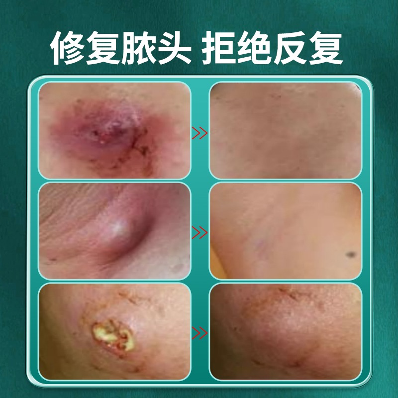 火疖子断痒拔毒膏拔脓膏粉瘤止痒皮脂腺囊肿屁股坐板疮吸脓头神器-图2