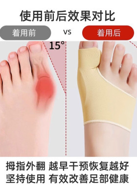 拇指外翻矫正器纠正脚趾突出神器