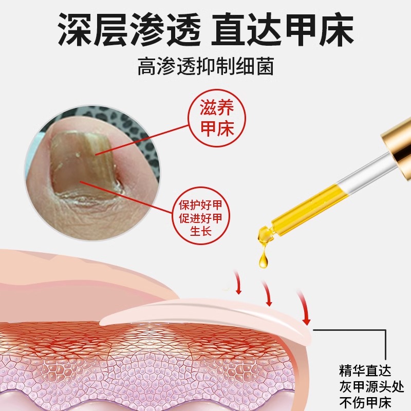 灰指甲专用液脱甲膏去增厚抑菌修甲沟修脚刀灰甲净真菌感冰醋酸炎-图1