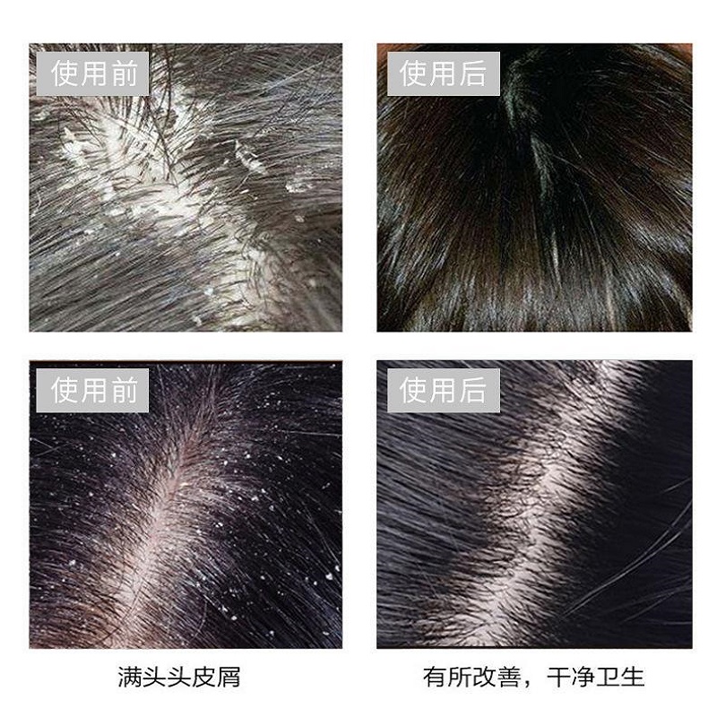 屑康王控油去屑止痒男女士驱洗头膏 天天特卖工厂店洗发水