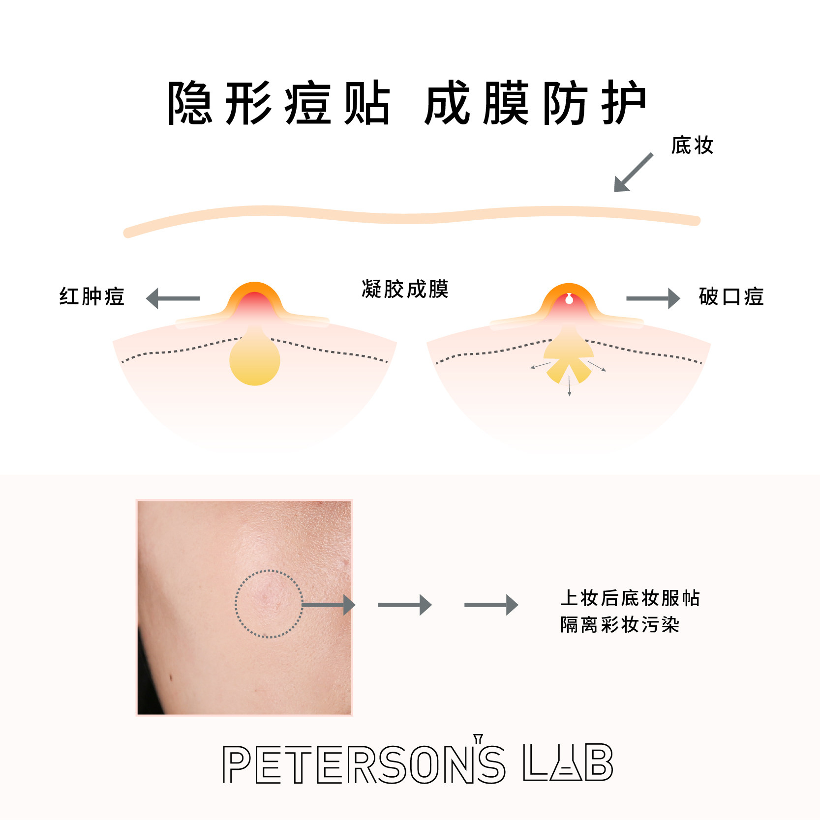 毕生之研2%水杨酸凝胶黑头痘痘贴 毕生之研液态精华
