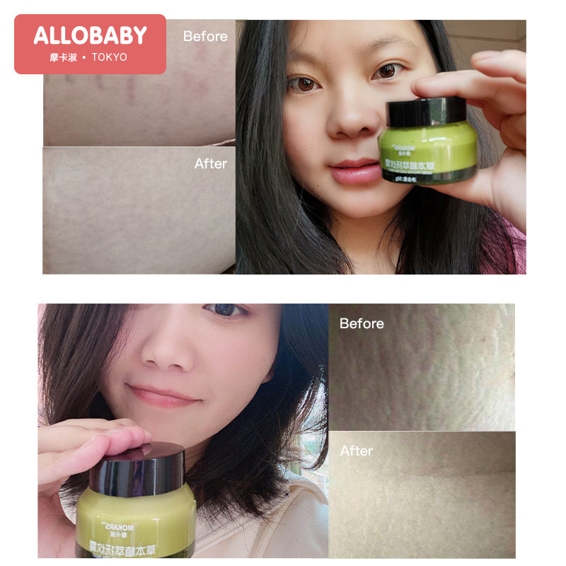 摩卡淑孕妇去祛除妊娠妊辰纹消除 摩卡淑妊娠纹护理