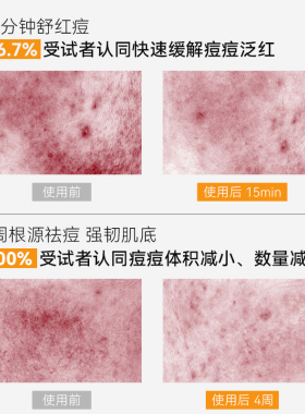 郁美净青少年控油净透面膜补水保湿舒缓痘痘泛红青春期13岁到18岁