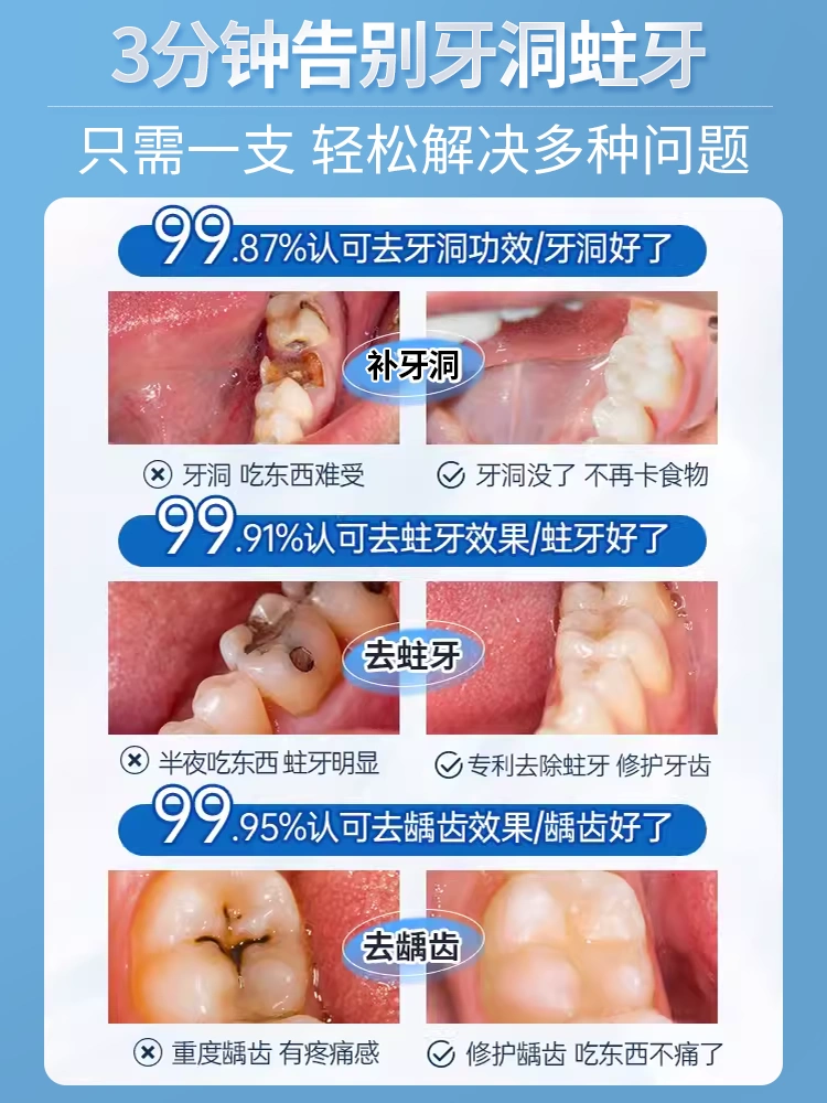 补牙神器自己在家补牙齿洞膏补牙缝堵牙洞神器蛀牙洞清理牙虫的药 - 图2