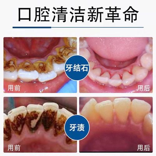 牙结石溶解牙石速效喷剂牙齿清洁工具牙黄牙垢黑渍去除器洗白神器-图0